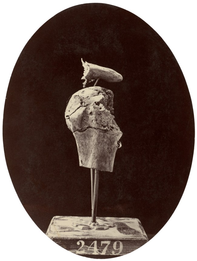 William Bell (American born England, 1830-1910) 'Successful Excision of the Head of the Humerus' 1864