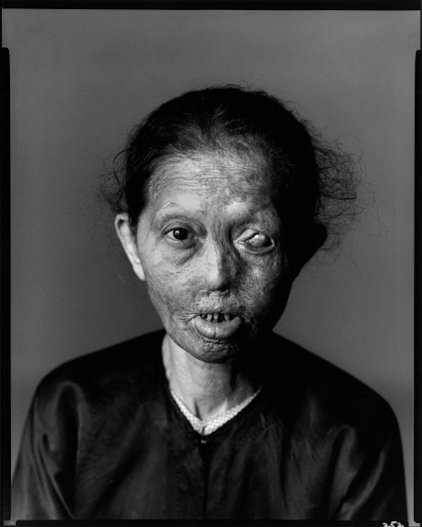 Richard Avedon (American, 1923-2004) 'Napalm Victim #1, Saigon, South Vietnam, April 29, 1971' 1971