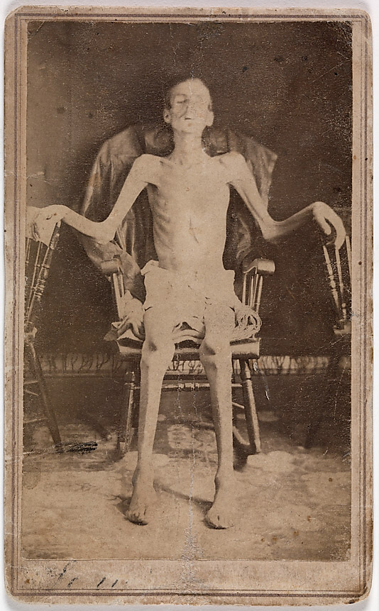 J. W. Jones (American, active Orange, Massachusetts, 1860s) 'Emaciated Union Soldier Liberated from Andersonville Prison' 1865