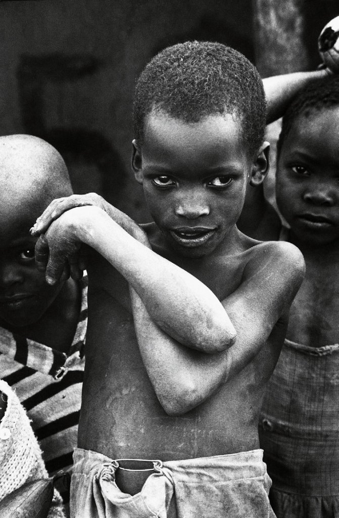 Jean Mohr (Swiss, 1925-2018) 'A young Mozambican refugee, Muhukuru clinic, Tanzania, 1968' Jean Mohr (Swiss, 1925-2018) 'A young Mozambican refugee, Muhukuru clinic, Tanzania, 1968'