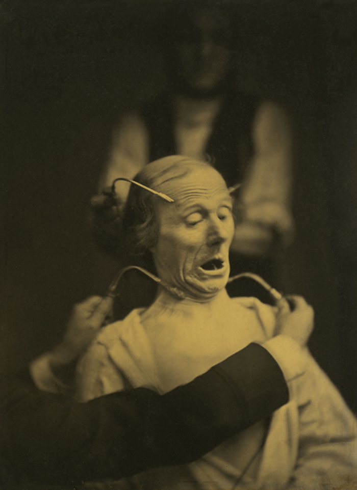 Dr Guillaume-Benjamin-Amant Duchenne (de Boulogne) (French, 1806-1875) 'Figure 63, "Fright" from "Mécanisme de la physionomie humaine (Mechanism of human physiognomy)" (1862)' 1854-1855 Dr Guillaume-Benjamin-Amant Duchenne (de Boulogne) (French, 1806-1875) 'Figure 63, "Fright" from "Mécanisme de la physionomie humaine (Mechanism of human physiognomy)" (1862)' 1854-1855