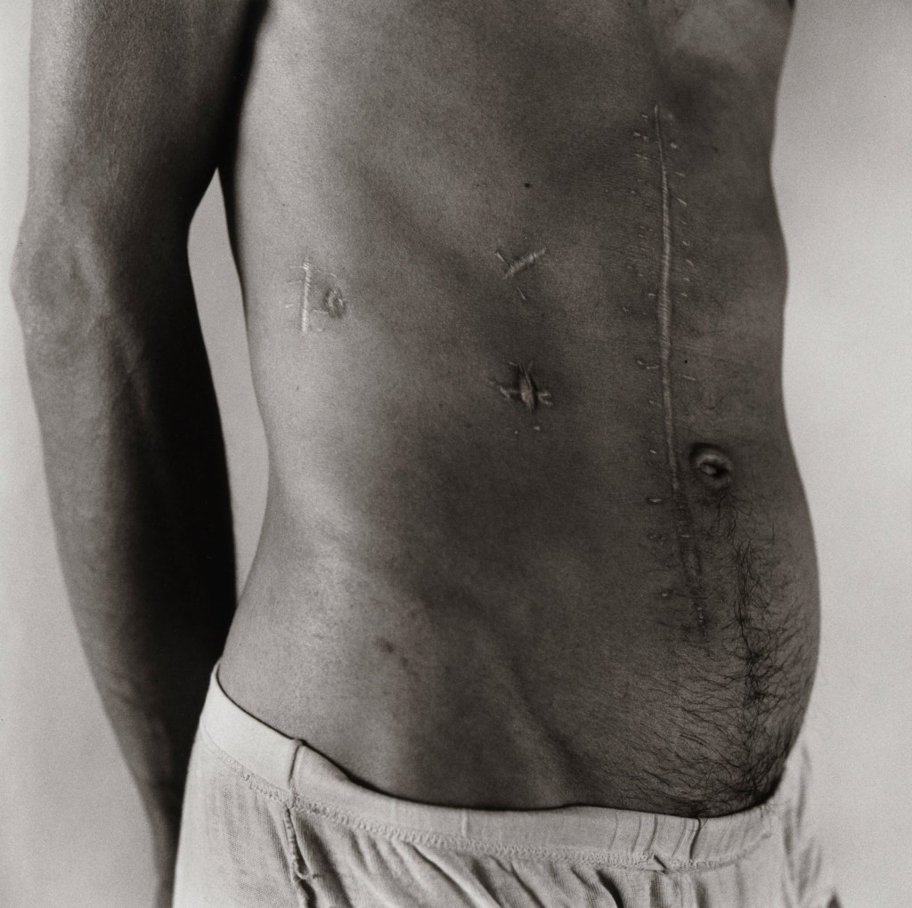 Peter Hujar. 'Pascal Imbert Scarred Abdomen' 1980