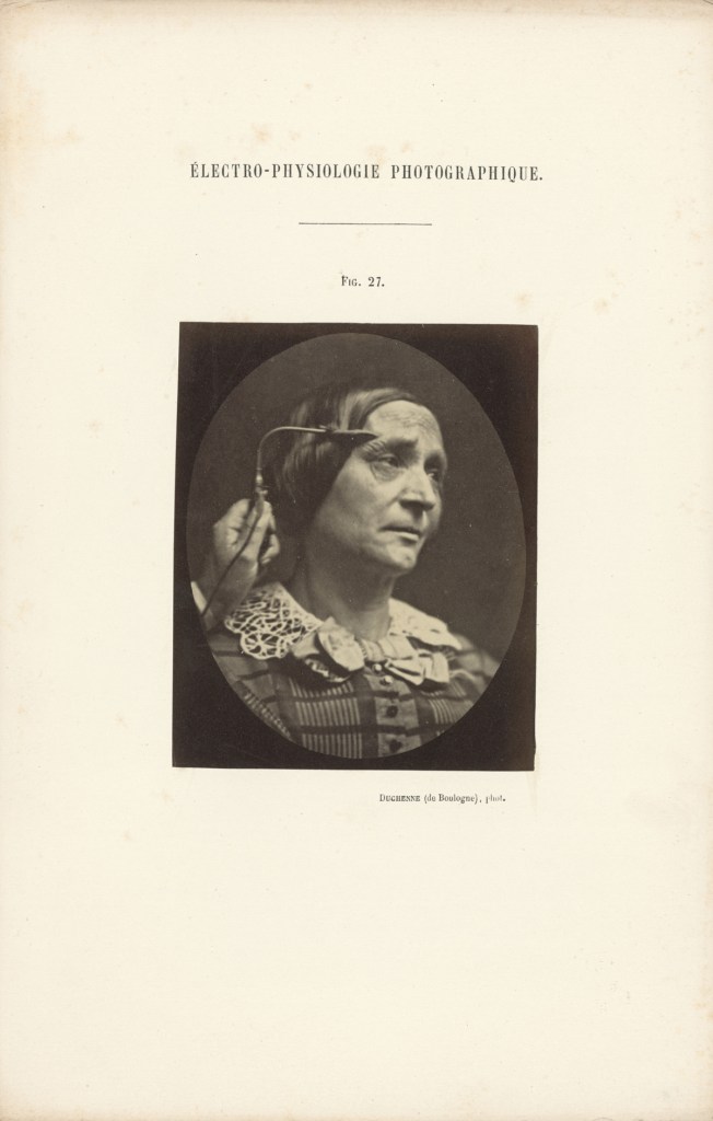 Guillaume-Benjamin Duchenne (French, 1806-1875) 'Figure 27, The Muscle of Pain' Negative 1854-1856; print 1876