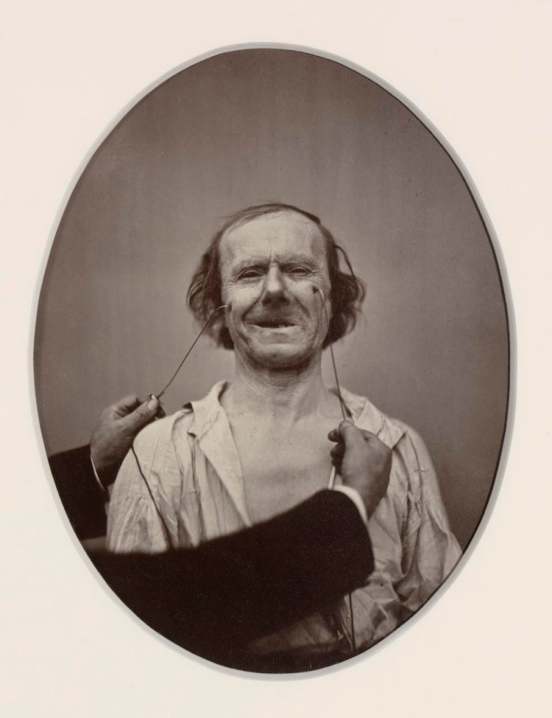 Guillaume-Benjamin-Amand Duchenne de Boulogne (French, 1806-1875) and Alban-Adrien Tournachon (French, 1825-1903) 'The Muscles of Weeping and Whimpering' About 1855-1857