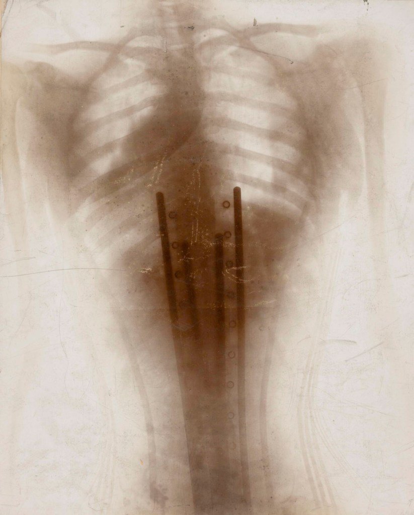 Henri Van Heurck (Belgian, 1838-1909) 'X-ray of chest deformed by corset' 1896-1897