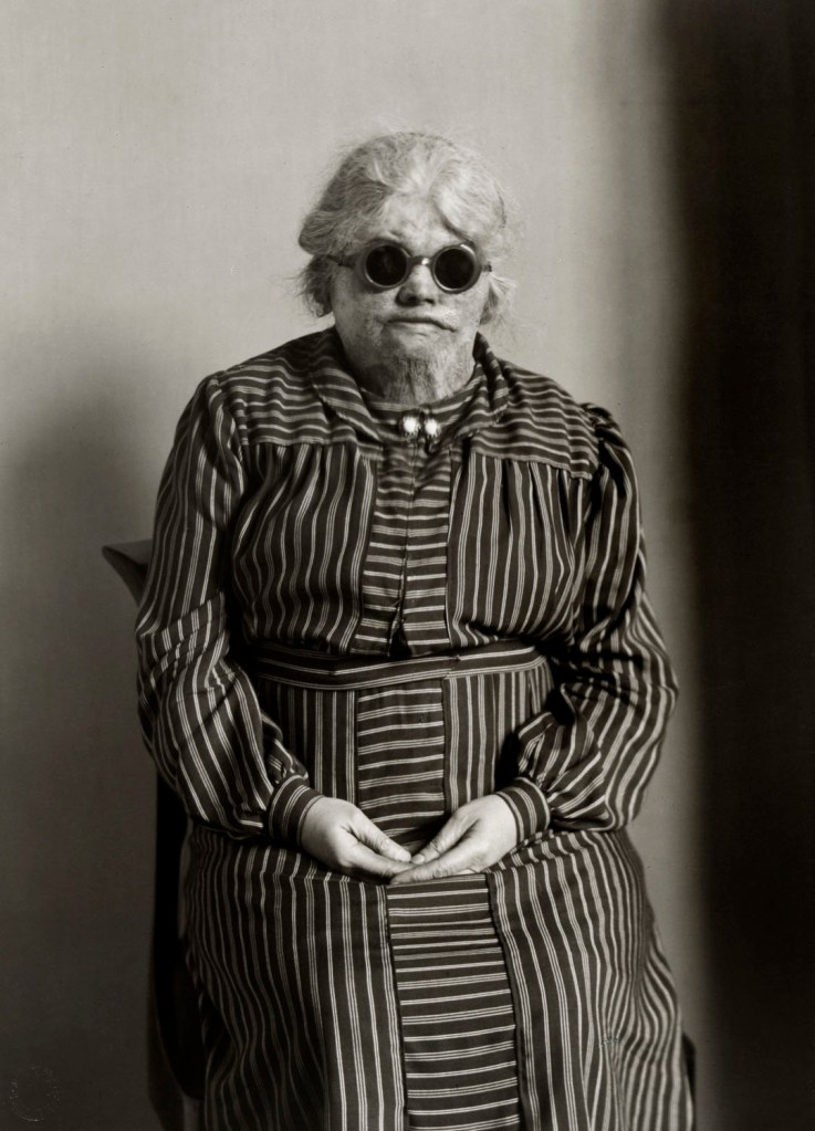 August Sander (German, 1876-1964) 'Victim of an Explosion' c. 1930, printed c. 1990-1999